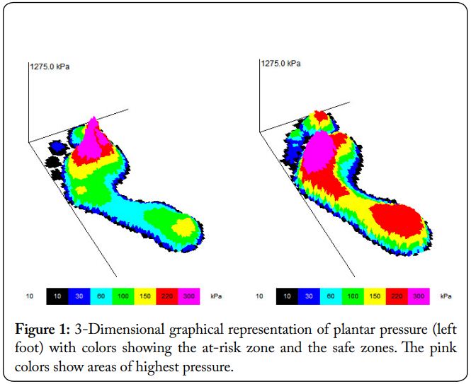 This can be attributed to the effect of high number of repetitions of specific motor tasks with visual/auditory– motor co-activation provided during task specific training.
#Diabeticperipheralneuropathy #Planterpressure #Exercises #Biofeedback #Riskoffall
jneuroscience.com/2020/01/25/imp…