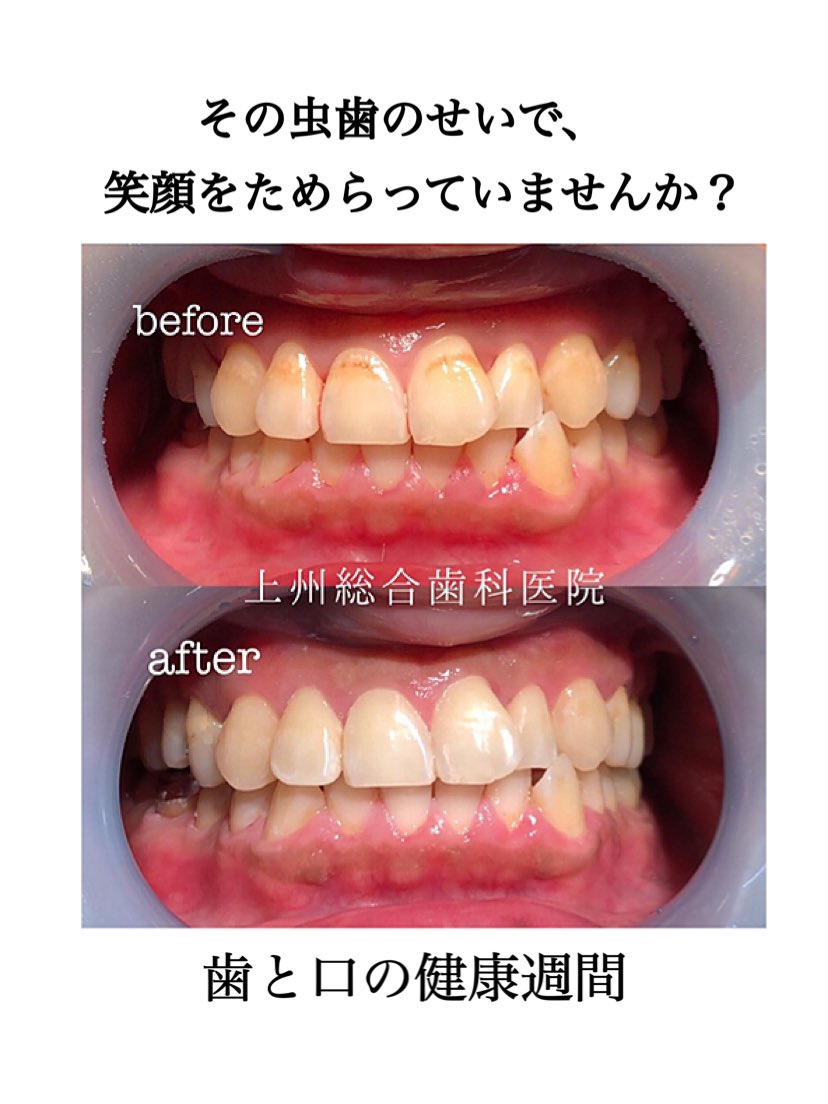 Jyousyu Dental Clinic Sur Twitter その虫歯のせいで 笑顔をためらっていませんか 虫歯を放置すると 歯がかけたり 歯の神経をとらないといけない事態になることもあります T Co Nivbcihfga 上州総合歯科医院 歯医者 虫歯 歯と口の健康習慣 Jyousyu Dental Clinic Sur Twitter その虫歯のせいで 笑顔をためらっていませんか 虫歯を放置すると 歯がかけたり 歯の神経をとらないといけない事態になることもあります T Co Nivbcihfga 上州総合歯科医院 歯医者 虫歯 歯と口の健康習慣