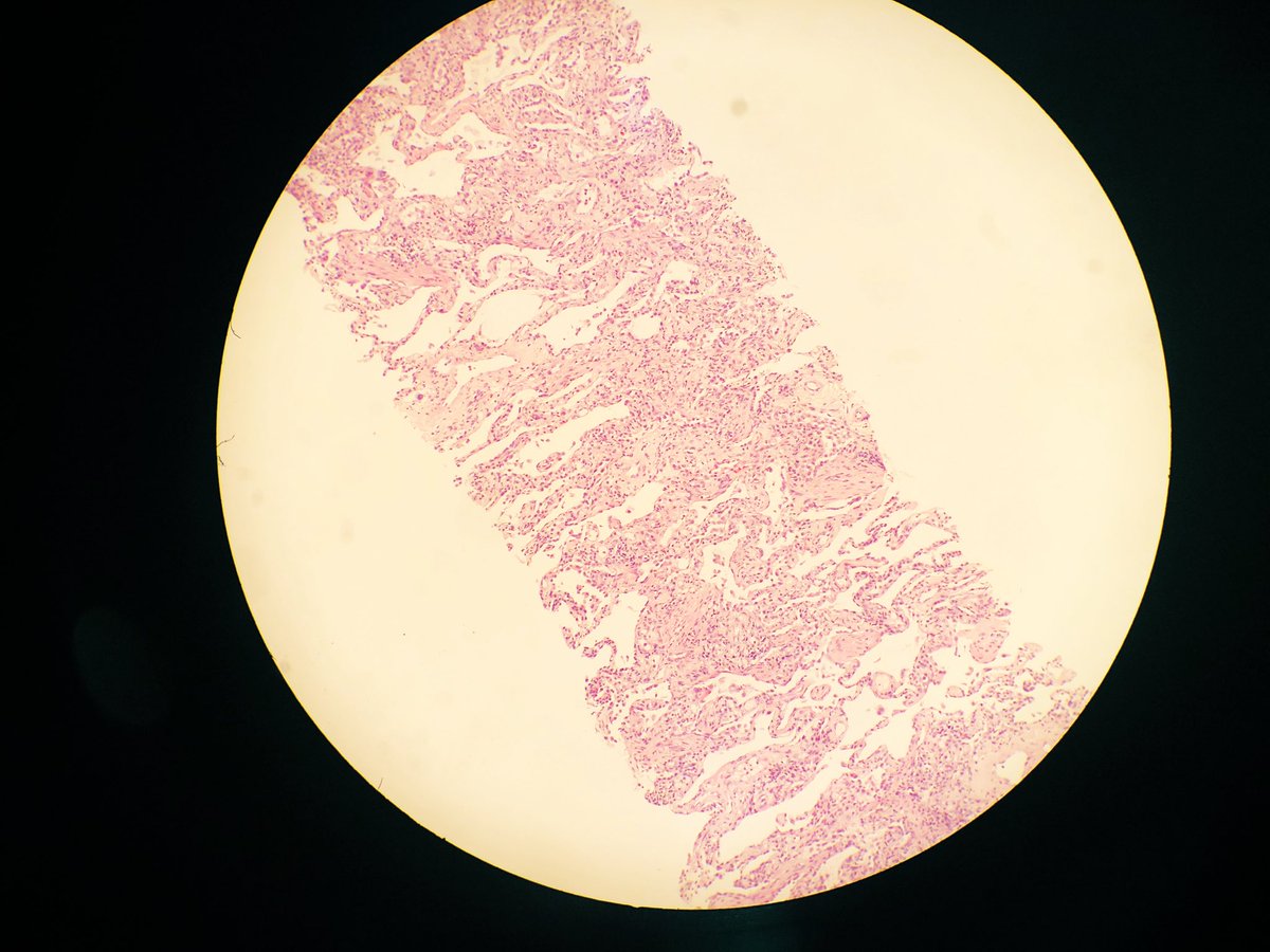 MiquelAngelC's tweet photo. DAD proliferative pattern in Lung Covid infection https://t.co/b3f5YM5MS6