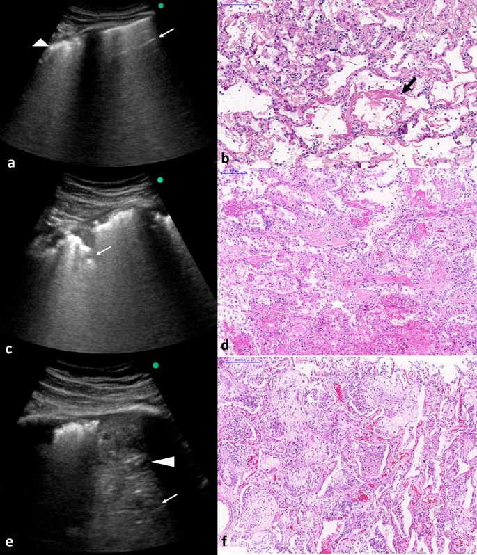 Histological–ultrasonographical correlation of pulmonary involvement in severe #COVID-19 bit.ly/3f06ObG #pocus @eHealth_EU @ehealth @WilsonLopezUs @SeeWithSound @LauraConangla @orhancinar @yaletung @ProbeMe @carlespedret @EM_RESUS @lunguk @jminardi21 @SonoStache