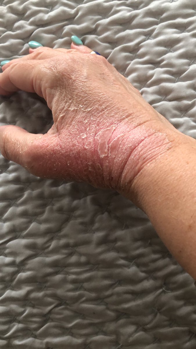 TracyAnnO's tweet photo. Thanks #burncollective for asking for a hand update . Getting a lot better but very itchy. You’ve all been very lovely 😊 11 days on. https://t.co/mHOtuGhRQJ