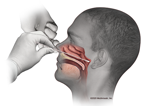 If you want to get tested at the old Elder-Beerman for Covid-19 but can't stand the thought of this, there's good news.  This long swab has been replaced by a much shorter one that barely goes into the nose.