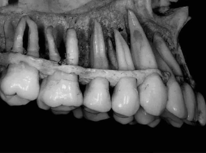 anatomical pic showing the alveolar process of maxilla bone and its associated structures↙️
 (crowns and roots of the teeth)