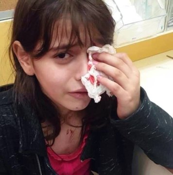 psyouth2020's tweet photo. She is Maryam Najib, she was playing outside her home in Jerusalem when illegal Isr*eli settlers attacked her with bricks and left her bleeding. She’s at risk of losing her eye. 
#Palestinian #PalestinianLivesMatter #Palestinian #PalestineWillBeFree https://t.co/OuiRM5uisS