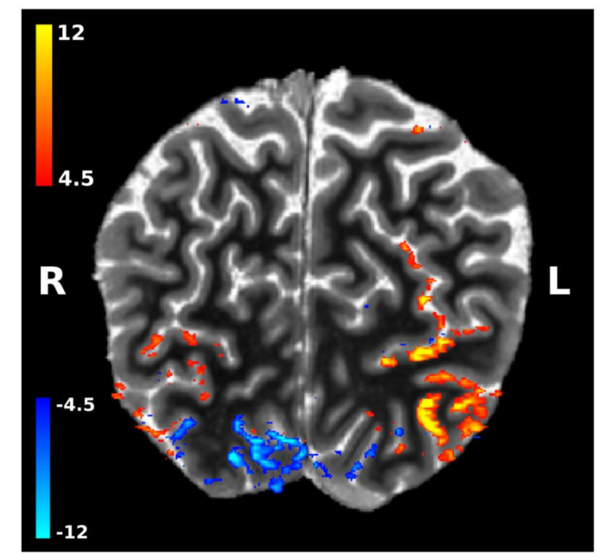 New layer-fMRI paper on feedback contributions to visual surface perception. doi.org/10.7554/eLife.…
