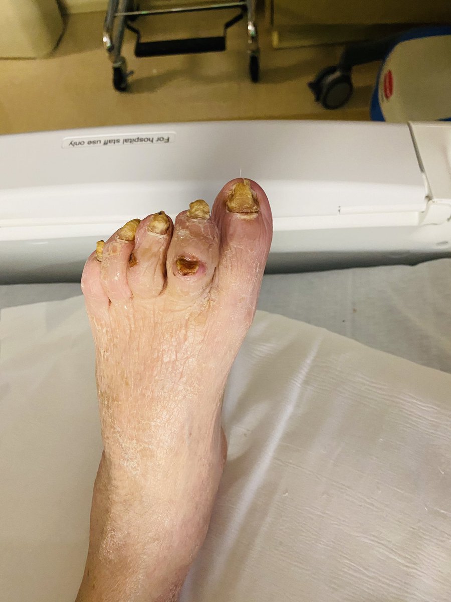 t_intheleadcoat's tweet photo. #NooptionCLI B/L feet.
Failed R #DVAโ>BKA, successful L DVAโ>8 month f/u. NO BKA so far. Looking forward to PROMISE ll outcomes. #Irad @SIRspecialists @SIR_ECS @CLIfighters @AMPSymposium #CLI #pDVA @CLI_LimFlow @JVIRmedia @EVToday #savethelimb @CAIRweb @pairsmedia @ACCinTouch https://t.co/MvbHTIN05M