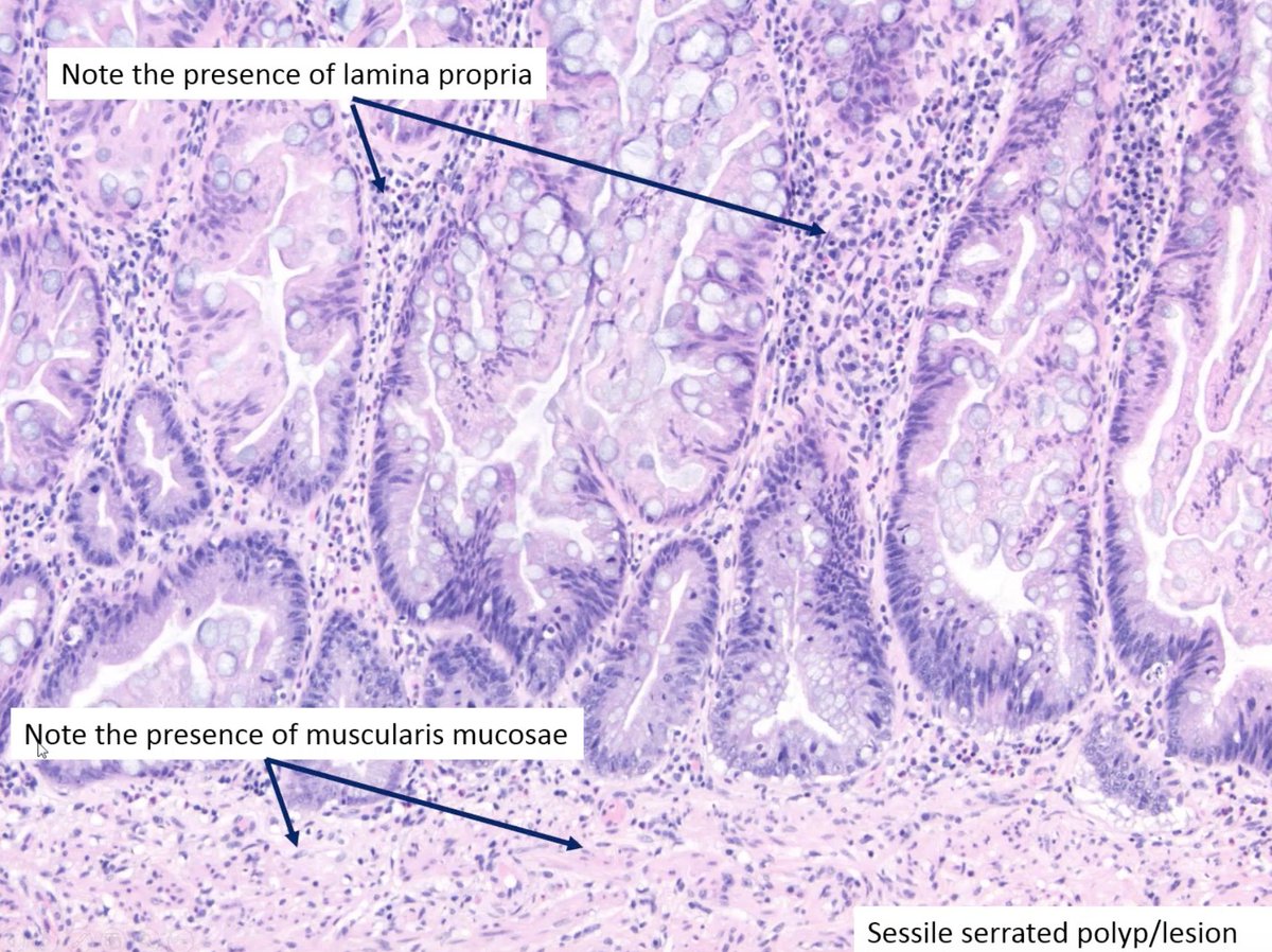 ALBoothMD's tweet photo. LAMN vs SSL -> look for your layers! @pezhouh #CAPvirtualpath #gipath https://t.co/hZEjryhooh