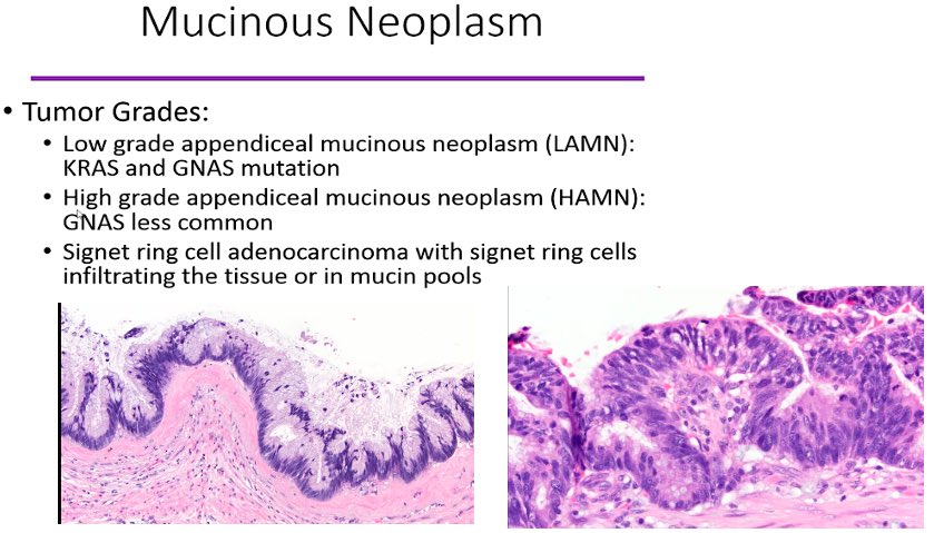 juliagallardo23's tweet photo. Appendiceal neoplasms discussed today by @pezhouh #CAPVirtualPath  #GIpath https://t.co/ft97cDy2mx