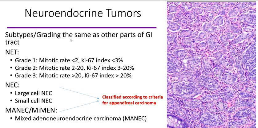 juliagallardo23's tweet photo. Appendiceal neoplasms discussed today by @pezhouh #CAPVirtualPath  #GIpath https://t.co/ft97cDy2mx