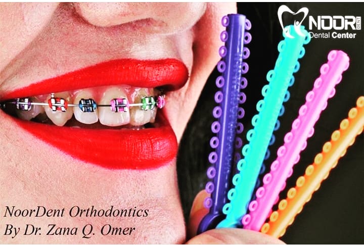 Thanks so much to <a href="/khalat_khalid/">Khalat Khalid</a> at @eds_orthodontics for this great pic of our #colourboutique ligatures  from one of her Erbil customers - Dr. Zana Q. Omer <a href="/noor/">Noor Ali-Hasan</a>.dental 😍