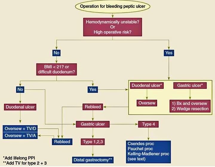 ✳️Algorithm for operation for bleeding peptic ulcer.⤵️