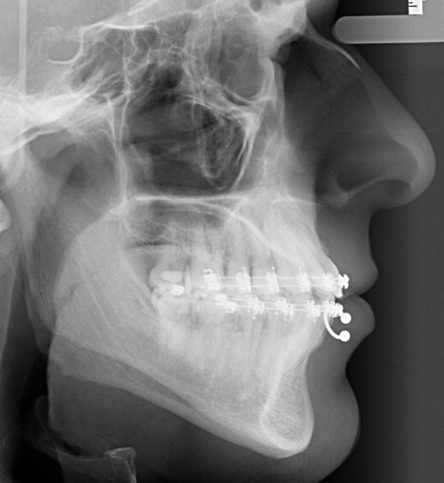 Dúvida Frequente: Porque é necessário tirar piercings do rosto para fazer  raio x?