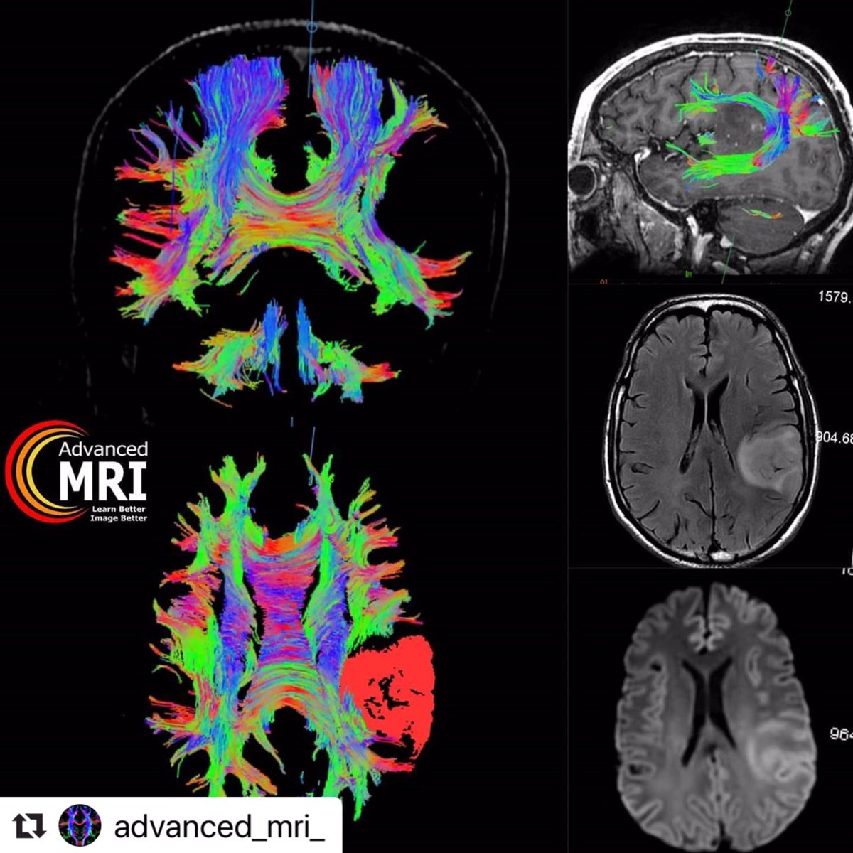 advanced_mri's tweet photo. #advancedmri #mri #dti #dwi #science #medicine #radiology #technology #radiologist #technologist https://t.co/BojI7AmjKD