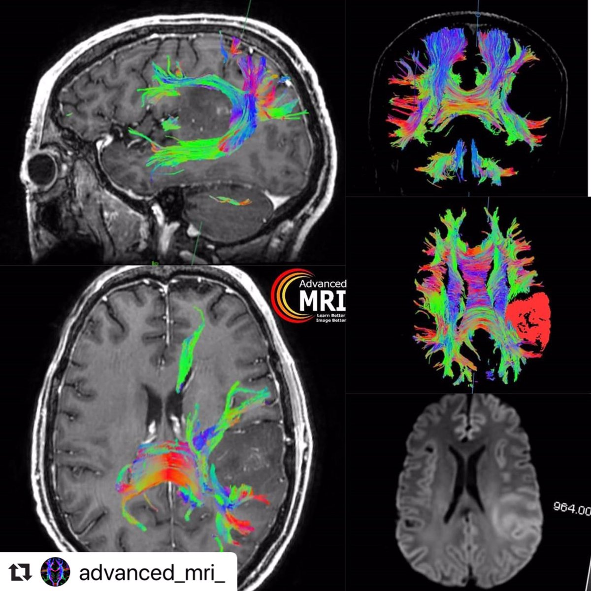 advanced_mri's tweet photo. #advancedmri #mri #dti #dwi #science #medicine #radiology #technology #radiologist #technologist https://t.co/BojI7AmjKD