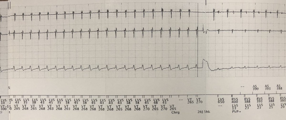 GVenkataramanEP's tweet photo. 30 yo with ICD shock.  Tracings of initiation, response to ATP, and termination.   EP Fellows in training, Diagnosis?  #EPeeps https://t.co/9xsMwZTwfH