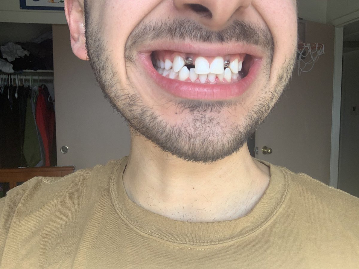 rodrothat's tweet photo. After 22 years of never having 2 of my teeth I can now finally say I have a full set of pearly whites https://t.co/EKk9uSfa8u