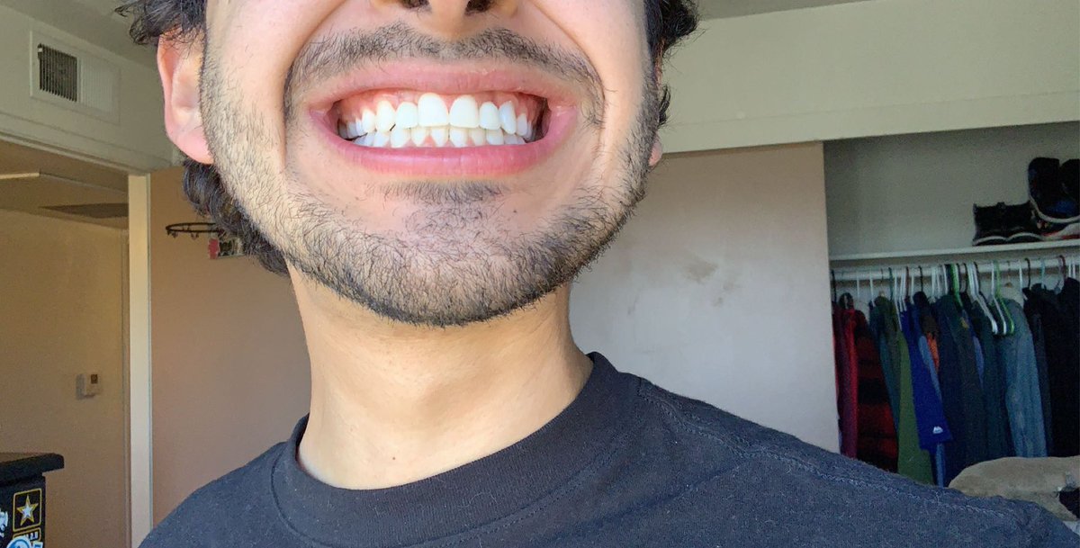 rodrothat's tweet photo. After 22 years of never having 2 of my teeth I can now finally say I have a full set of pearly whites https://t.co/EKk9uSfa8u