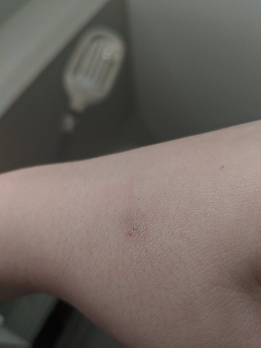 Casualties of war when trying to film new content . Yes I am a giant baby thank you https://t.co/BOe<a href="/tag/camgirl"class="tags"><span>#camgirl</span></a><a href="/tag/nsfw"class="tags"><span>#nsfw</span></a><a href="/tag/chaturbate"class="tags"><span>#chaturbate</span></a>