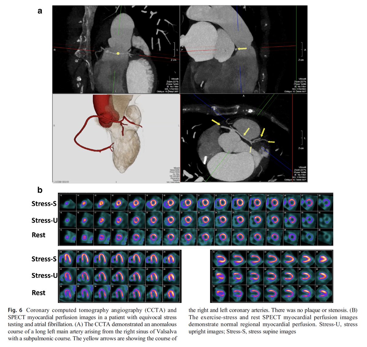 Excited to share our recent Case-Based Review on the clinical application of SPECT versus PET MPI in patients with equivocal CCTA. Thank you for your exceptional mentorship @mdicarli. @SpringerCurRpts @BrighamResearch @BWHCVImaging #cardiotwitter #multimodalityimaging