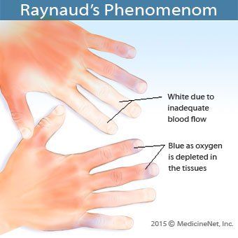 MedicineNet's tweet image. What #triggers #Raynaud&apos;s phenomenon? #SkinChanges #Rheumatic
buff.ly/3f0fvTH