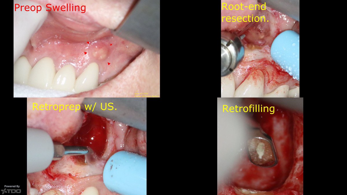 modernendoATL's tweet photo. Instantly healed!!! Just kidding. This is an apico with a membrane and bone grafting, which gives a very pleasing postop radiograph 😉. The well-delineated lucency is often indicative of a cyst (which it was in this case). https://t.co/yvdBgdsirk