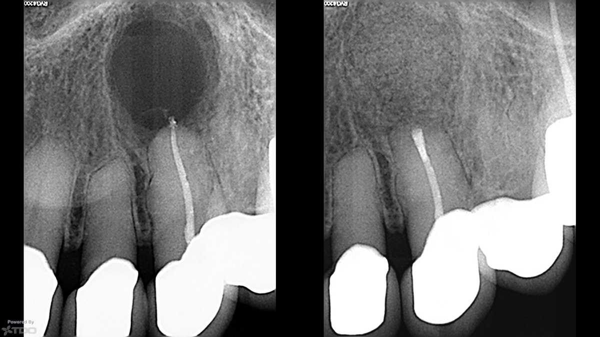 modernendoATL's tweet photo. Instantly healed!!! Just kidding. This is an apico with a membrane and bone grafting, which gives a very pleasing postop radiograph 😉. The well-delineated lucency is often indicative of a cyst (which it was in this case). https://t.co/yvdBgdsirk