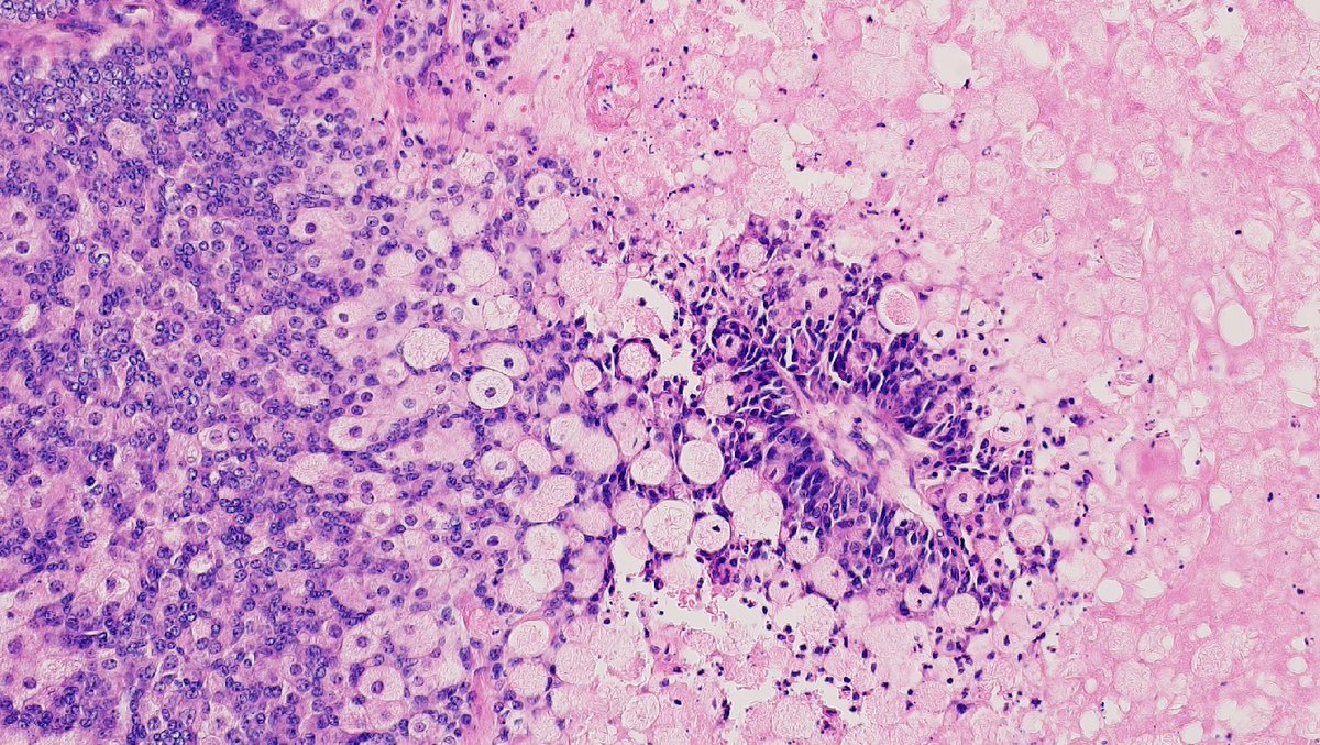 62/F with no other history of tumor presented with this ovarian mass. Whole tumor looks like this. No teratoma found in the ovary #GYNpath