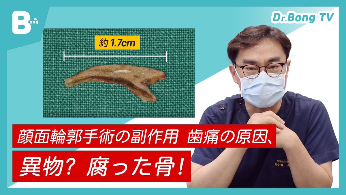 cbk_ps's tweet photo. ▶︎▶︎▶︎Dr.Bong TV◀︎◀︎◀︎
“チェボンギュンの顔の骨のお話”Vlog⭐️

episode.26
輪郭手術を受けたのに歯が痛い⁉️

歯とは何の関係もない手術後に起きた
不可解な歯の耐えられない痛み…🦷

実際の執刀医も分からなかったその原因
チェボンギュン院長が治します✨

☞https://t.co/Pxbh07IDkk https://t.co/90RttLfeTa