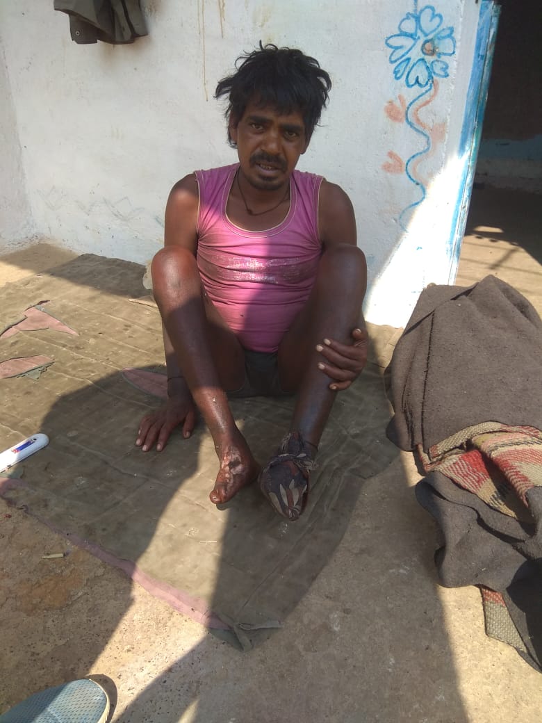 ChetanBhargava6's tweet image. इस ट्वीट को रीट्वीट करने वाले सभी लोगो को आज फॉलो करने वाला हूँ क्योंकि राकेश आदिवासी की जीवन-मृत्यु का सवाल है उसे हमें बचाना है 1 साल से दोनों पैर के पंजे में केंसर है मुझे कल सूचना मिली @ChouhanShivraj जी यह गाँव अचलगढ़-मुंगावली जिला अशोकनगर के है। @DrKPSinghYadav संज्ञान ले।