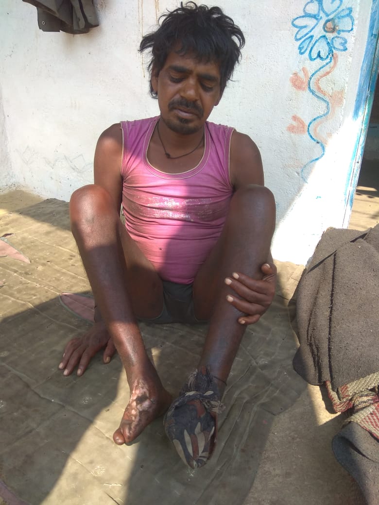 ChetanBhargava6's tweet image. इस ट्वीट को रीट्वीट करने वाले सभी लोगो को आज फॉलो करने वाला हूँ क्योंकि राकेश आदिवासी की जीवन-मृत्यु का सवाल है उसे हमें बचाना है 1 साल से दोनों पैर के पंजे में केंसर है मुझे कल सूचना मिली @ChouhanShivraj जी यह गाँव अचलगढ़-मुंगावली जिला अशोकनगर के है। @DrKPSinghYadav संज्ञान ले।