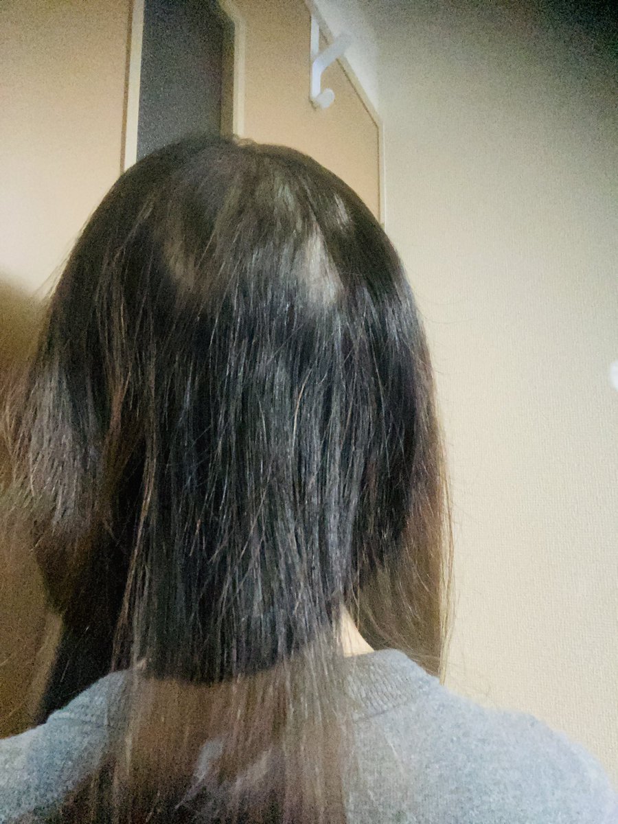 とりこ 去年から始まった抜毛はこんな感じ クラスの人になんて言われるのかな 怖いな 辛いな 抜毛症 精神障害 不眠症