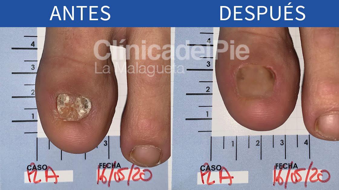 Todo lo que debes saber sobre cómo reconstruimos las uñas, se acabaron los complejos para esta verano. ¡Luce tus pies! 😎☀️. #podologo #podologia #estetica #pie #verano #uñas 
 clinicadelpielamalagueta.com/blog/reconstru…