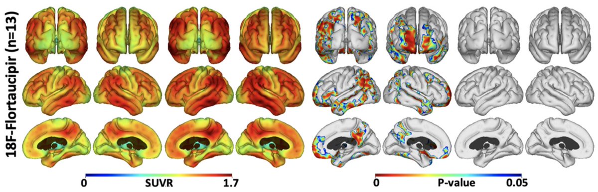 FDA approves Tauvid™, the first novel  PET imaging agent for the detection of tau protein tangles, an important pathological marker of tauopathies such as #Alzheimers and #Parkinsons, for aiding the diagnosis and progression of #Alzheimers.
fda.gov/news-events/pr…