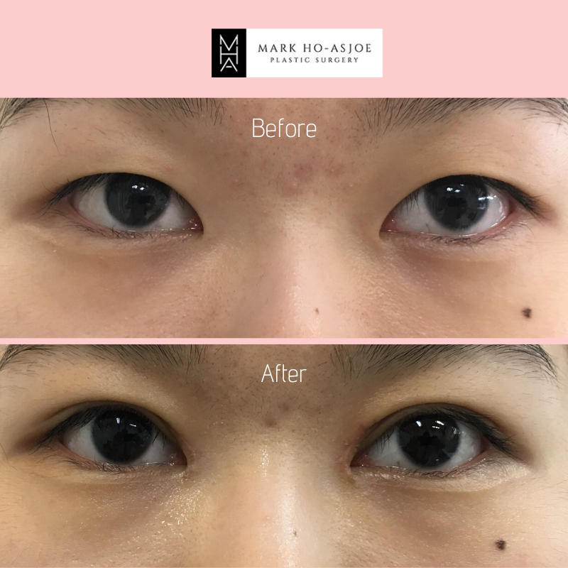 markhoasjoe's tweet photo. There are various facial procedures surgical and non-surgical dependent on your treatment or requirement. Take a look on the website.
https://t.co/PJaSMOCQHo #facialsurgery #nonsurgical #facelift #doubleeyelift #rhinoplasty #earcorrection #facialrejuvenation https://t.co/VILbZP91Cf