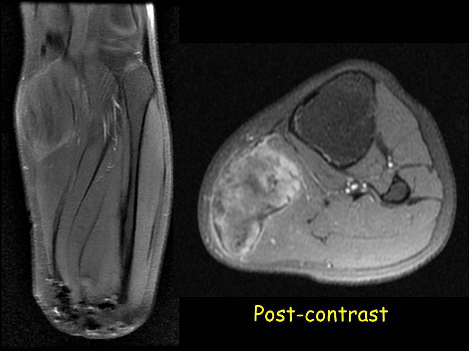 19yo male, transtibial amputation secondary to trauma since 1year. Pain at the amputation stump since 8 months. What is your hypothesis? #amputation #mri #mskradiology #radiology