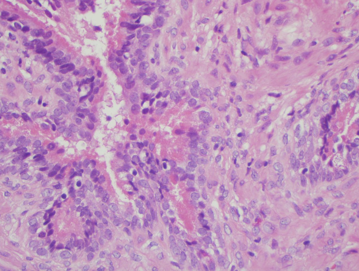 natzpat's tweet photo. Pretty paneth cell like metaplasia in TURP specimen! #gupath #GIpath https://t.co/ilAupO7nyE