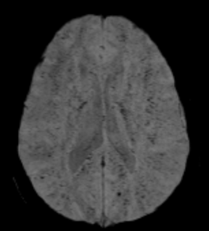 mdneurorads's tweet photo. Answer:
Fat embolism syndrome after long bone fracture in MVC
Explore full DICOM study via @pacsbin
MR: https://t.co/81asB210cT ⬅️
Thanks for participating in the poll!
#Radres #Neuroradiology #FOAMrad #FOAMed #NeuroRad #radiology #Radfellow #Traumarad #Trauma #MedTwitter https://t.co/Q7xGz99CDG