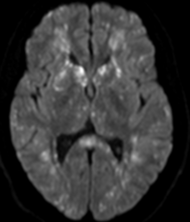 mdneurorads's tweet photo. Answer:
Fat embolism syndrome after long bone fracture in MVC
Explore full DICOM study via @pacsbin
MR: https://t.co/81asB210cT ⬅️
Thanks for participating in the poll!
#Radres #Neuroradiology #FOAMrad #FOAMed #NeuroRad #radiology #Radfellow #Traumarad #Trauma #MedTwitter https://t.co/Q7xGz99CDG