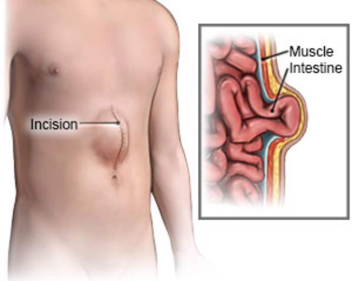CiruAndes2's tweet photo. Recommendations for minimize the rate of incisional hernia after laparotomy closure!  #SoMe4Surgery #SoMe4ColSurg @MISIRG1 @pferrada1 @SWexner @juliomayol @sminaev2015 @NeilFlochMD @almagoch @anhanssen @TecSurgeon @FitSurgeon @GICEQ1 https://t.co/fUf7Rz02b5