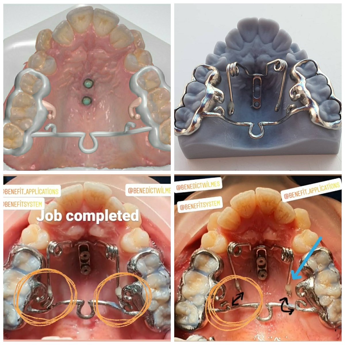 Bizleri de geliştiren hekimlerimizle yeni ürünler çalışmaktan keyif alıyoruz.🤓  🙋‍♂️ #orthodonticscrews
#DigitalHyrax #DigitalTPA #DigitalDentistry #Digitalorthodontics   #DigitalAppliances #DigitalBandLoop  #dijitaldişhekimliği #dijitalortodonti #orthodontist 
#orthodontics