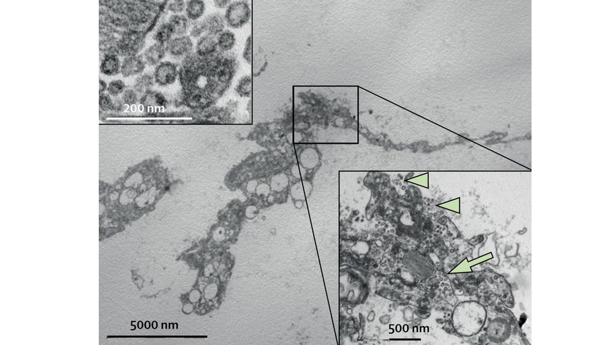 AREMIM4's tweet photo. Microfotografía electrónica del virus #SARSCoV2 invadiendo un neumocito tipo 2 🫁
Serie de 38 autopsias en 🇮🇹  El 87% de los pacientes presentaron microtrombosis arterial (vasos <1mm)
Doi: https://t.co/mBeLnm0OX9 https://t.co/ERUWbFSmRq