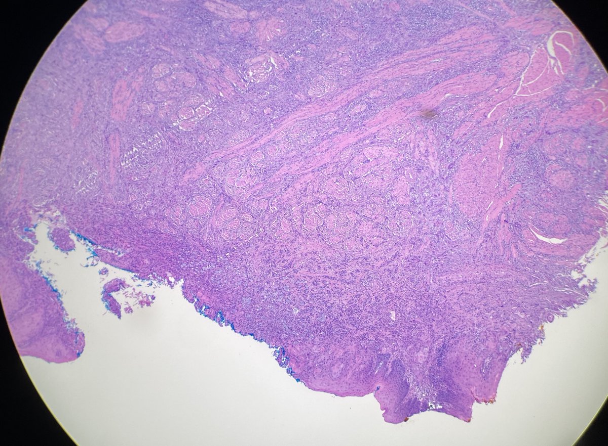 oralpath's tweet photo. Lesion on left lateral border of the tongue.

#OralPath
#ENTPath
#HNPath https://t.co/fOD9GRdE3t