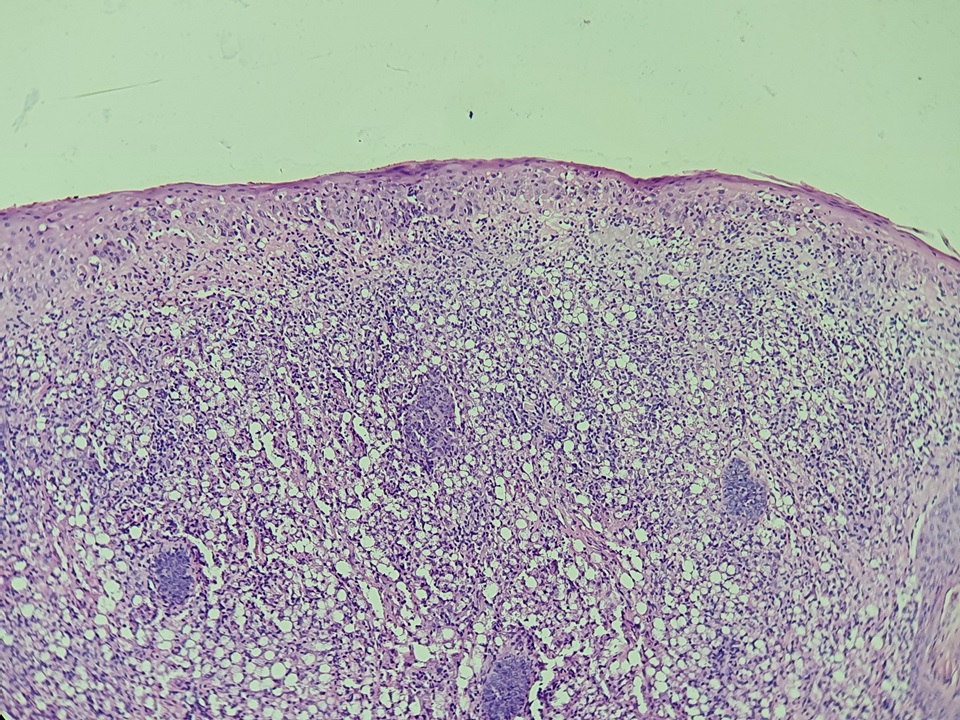 RobledoRochaMD's tweet photo. Cutaneous nodule on the nose of this extrativist forest worker. Look at all those Leishmania amastigotes positioned on the periphery of macrophages cytoplasm in a characteristic clock-face arrangement, referred as Leishman-Donovan bodies. https://t.co/W9J0AY0MAn