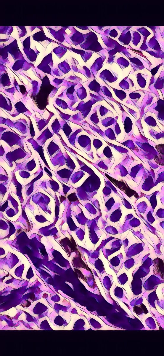 AbbiePath's tweet photo. The phone wallpaper this evening is a #melanoma ! #dermpath #pathart https://t.co/zKV1bUrZZ8