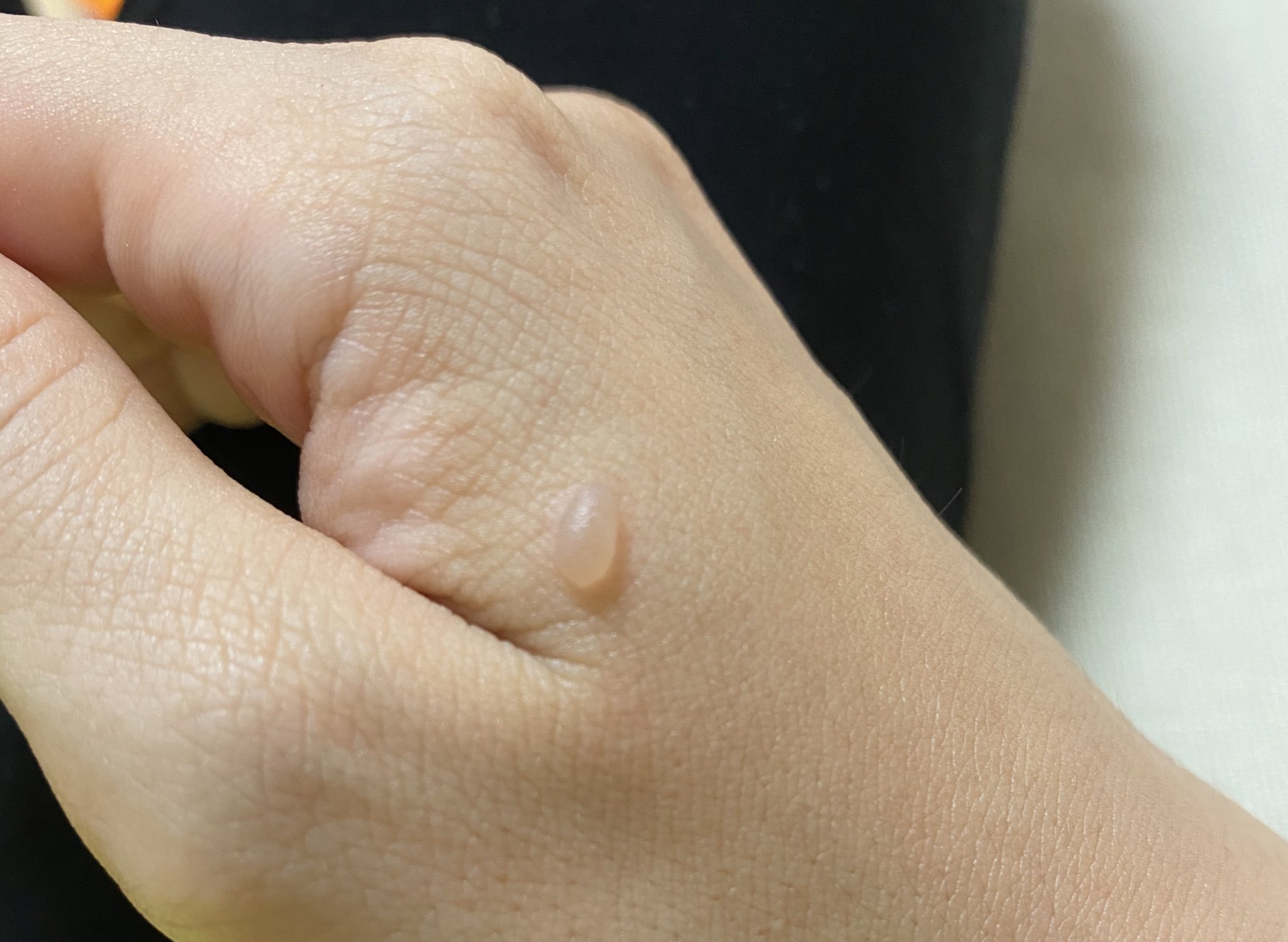 今そっち 唐揚げで火傷してもーたー ひっくり返してたからすぐに冷やせず水ぶくれにー やたら透明感あるな なんか形もかわいいな なんやお前 T Co 2zbtfwaflc Twitter