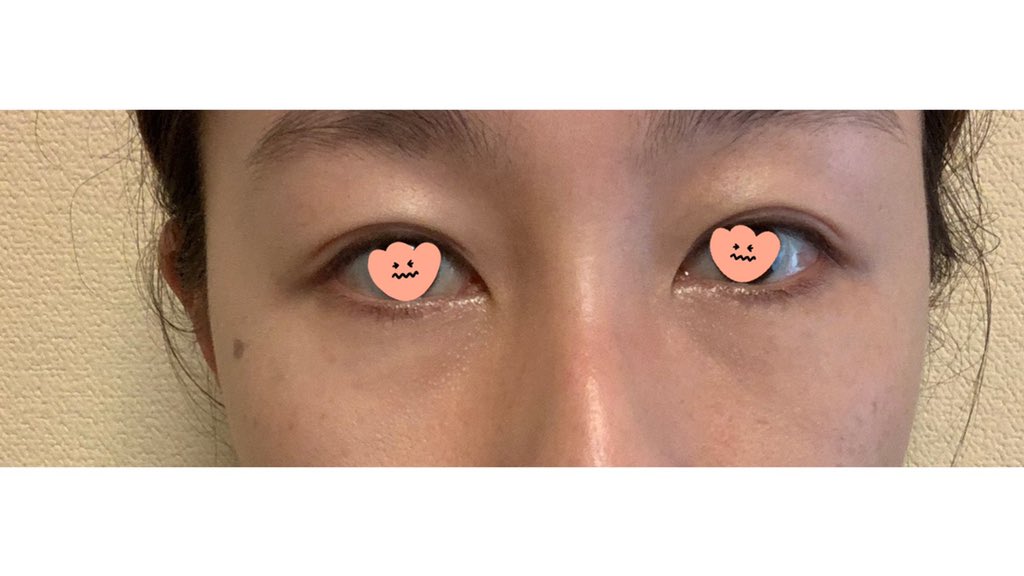 目の下の脂肪取り Hashtag V Twitter