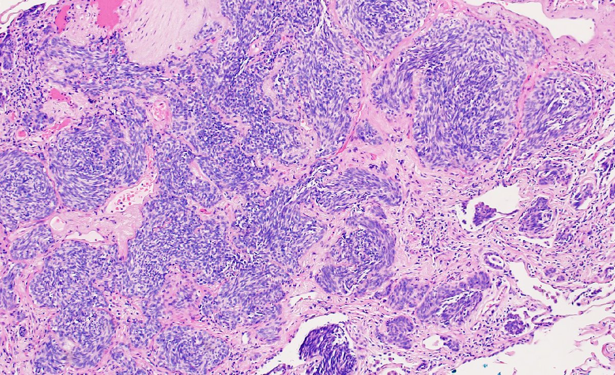 mhassanaimc's tweet photo. Look what we find in lung. Roaming around😜 #pulmpath https://t.co/Db9NT4LthQ