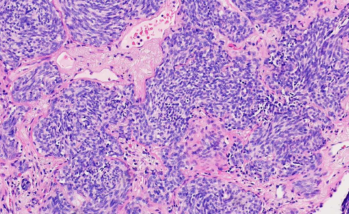 mhassanaimc's tweet photo. Look what we find in lung. Roaming around😜 #pulmpath https://t.co/Db9NT4LthQ