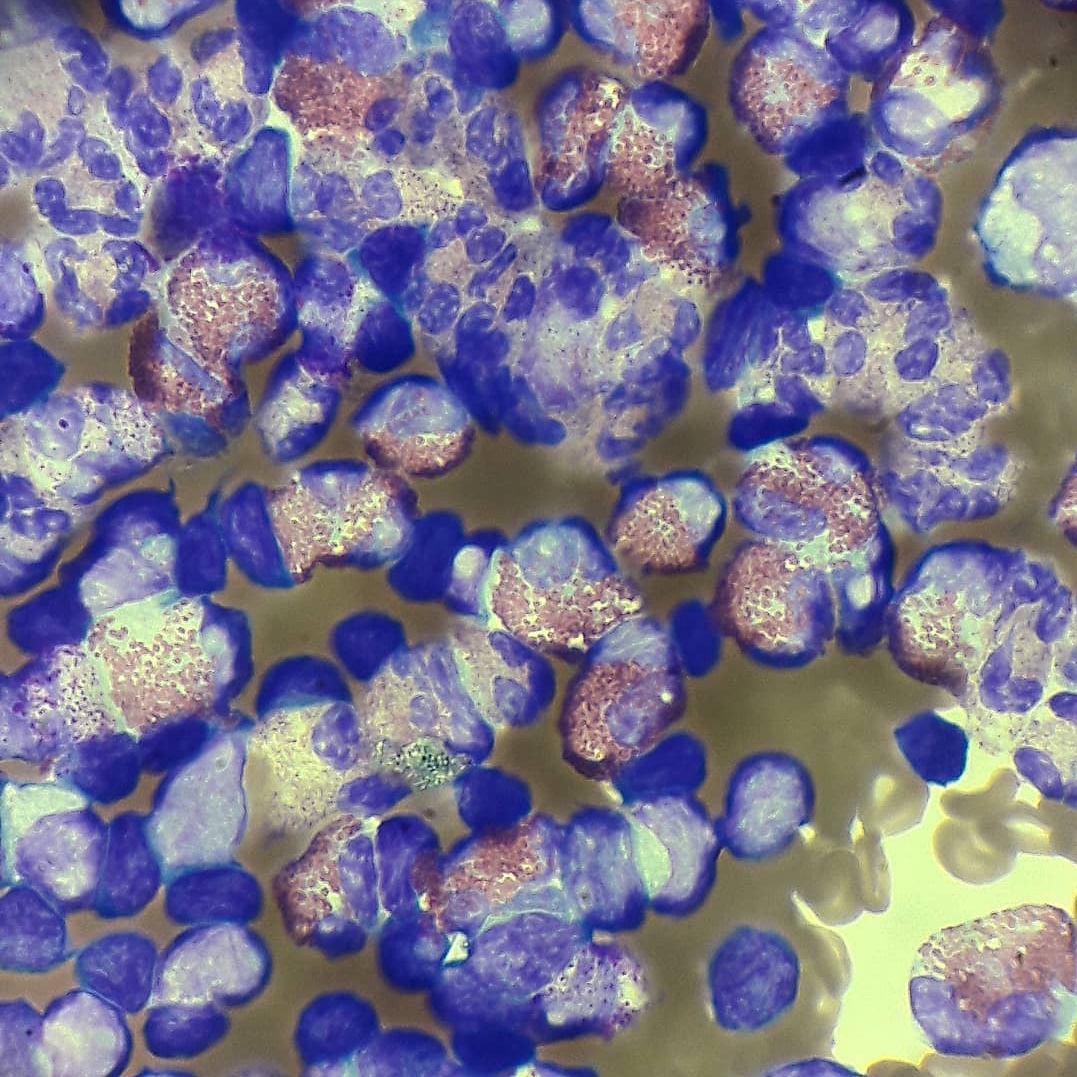 hj_mayah's tweet photo. Interesting find in pleural fluid.... Lots of eosinophils... (>10% of nucleated cells) known as “eosinophilic pleural effusion”. Associated with malignancies, pleural exudates, pneumothorax among others...#pleuralfluid #eosinophils #pathology #🫁🫁🫁 https://t.co/bK16ZBkYHU