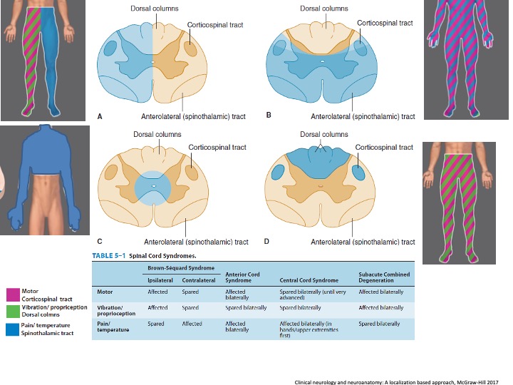 SYRINX/Central cord syndromeAffects crossing fibers of STTs at cervical level=upper extremity fibers so loss of pain/temperature in hands with sparing motor/vib/propSubacute combined degeneration: DCs & SCTs= vib/prop/weakness with spared pain/temperatureCause=B12 deficiency